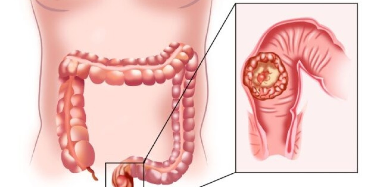 Global Anal Cancer Market Expands with Immunotherapy as Frontline Standard