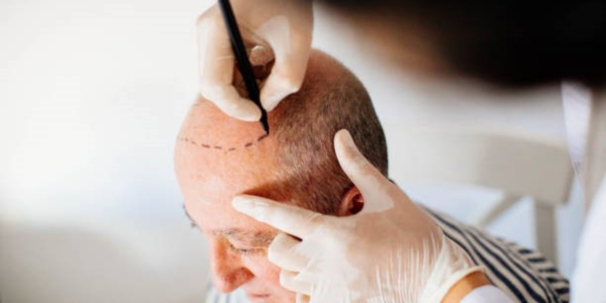 Hair Transplant in Riyadh: Before and After Success Stories