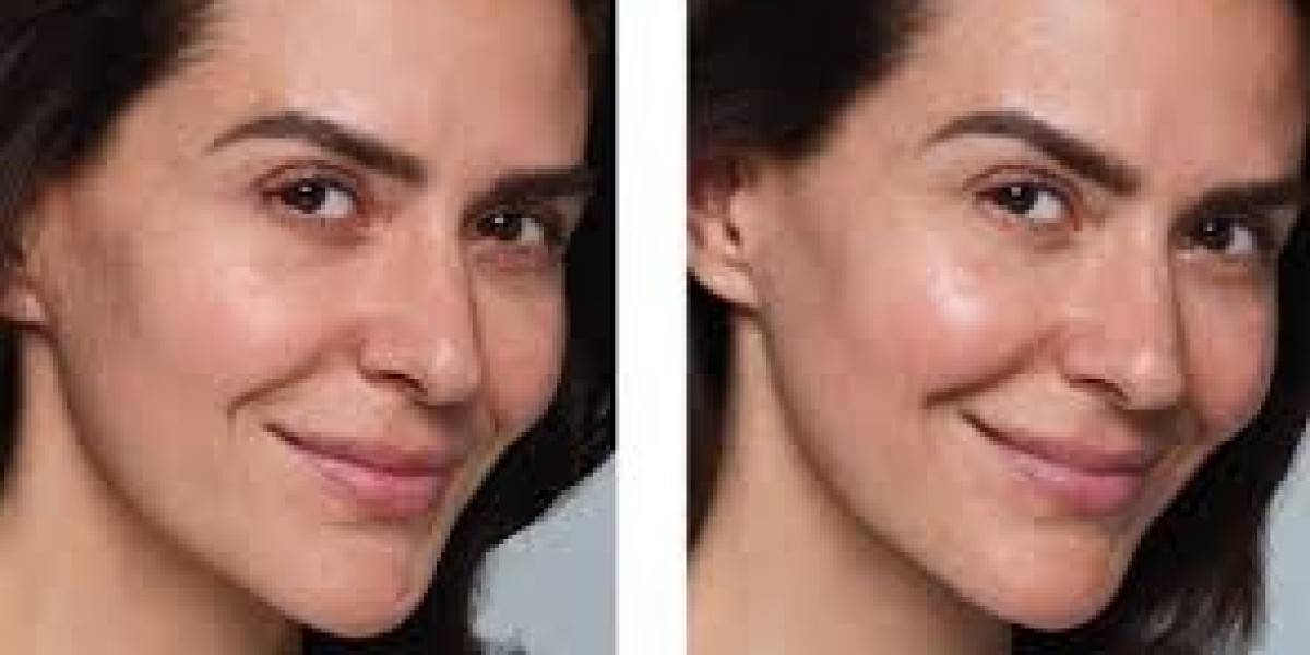 Skin Texture Treatment