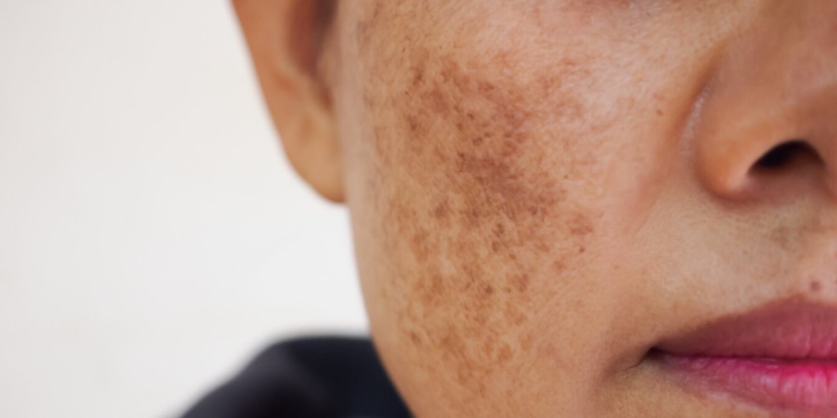 The Role of Hormones in Melasma: What Women Need to Know