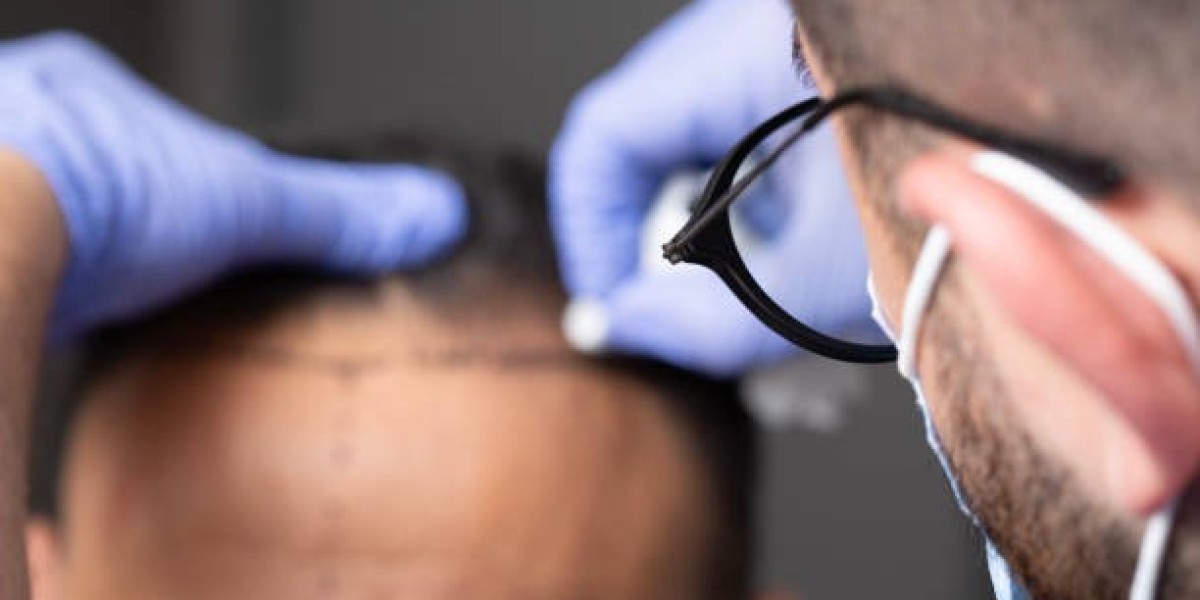 Hair Transplant in Riyadh: Addressing Your Questions for a Fuller Future