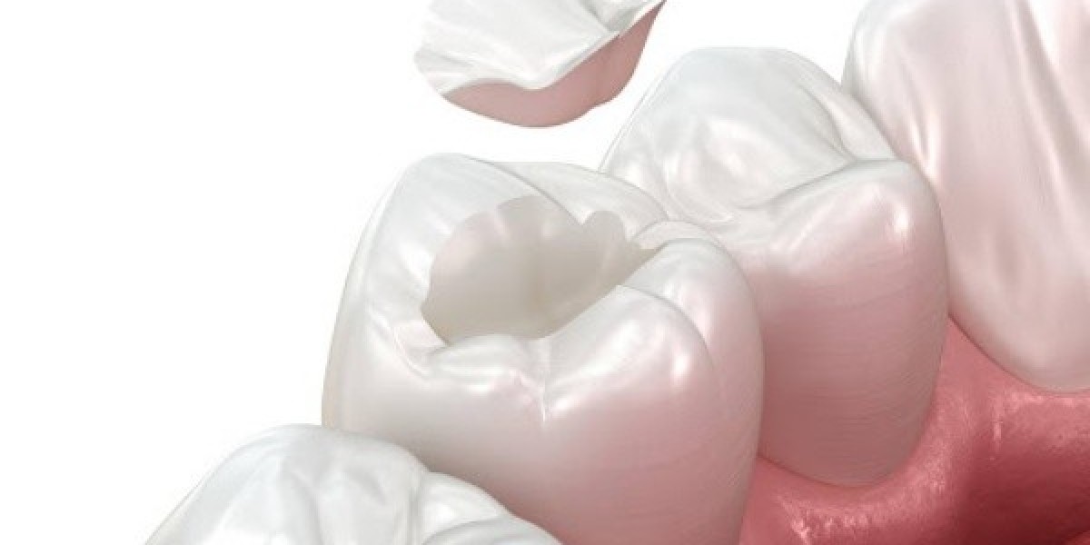 Quy trình trám răng: Những điều bạn cần biết về quá trình và chi phí