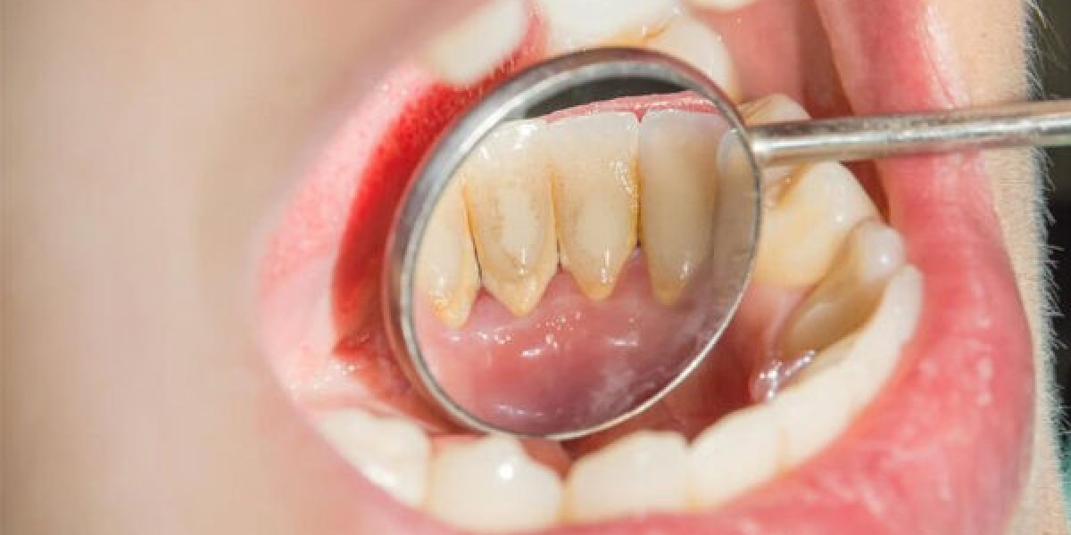 Có nên lấy cao răng không? Những lý do khiến bạn cần thực hiện sớm