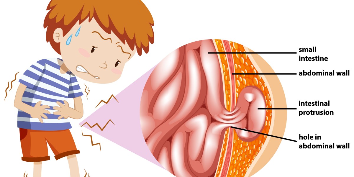 Advanced Hernia Surgery in Chennai – 21+ Years of Trusted Experience