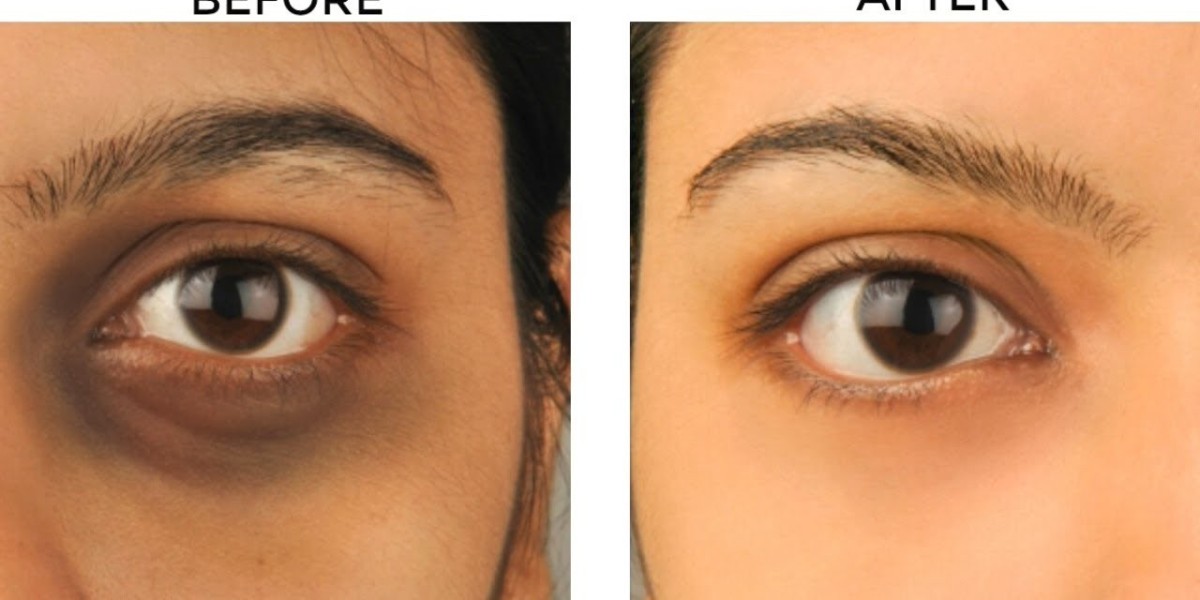 Iron Deficiency and Dark Circles: Islamabad Doctors Explain the Link