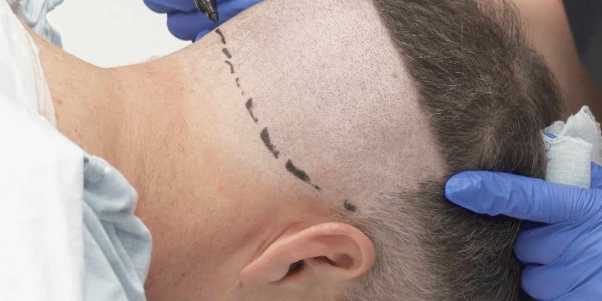 Hair Transplant in Dubai for a Full, Natural Hair Comeback