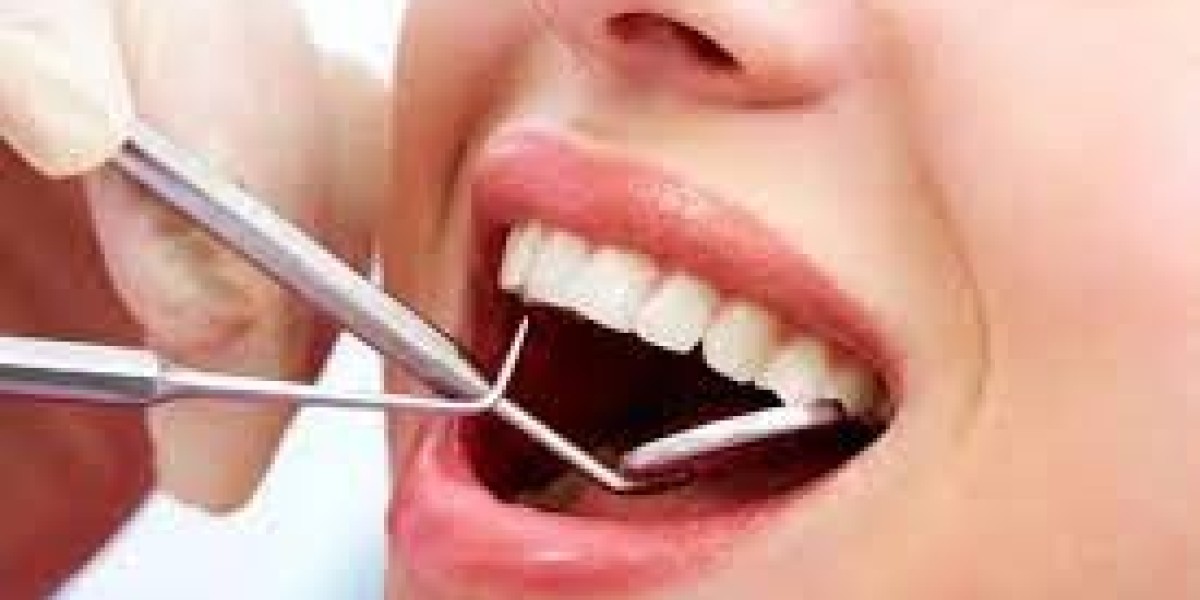 Bọc răng sứ không mài có thật không? Ưu nhược điểm cần biết