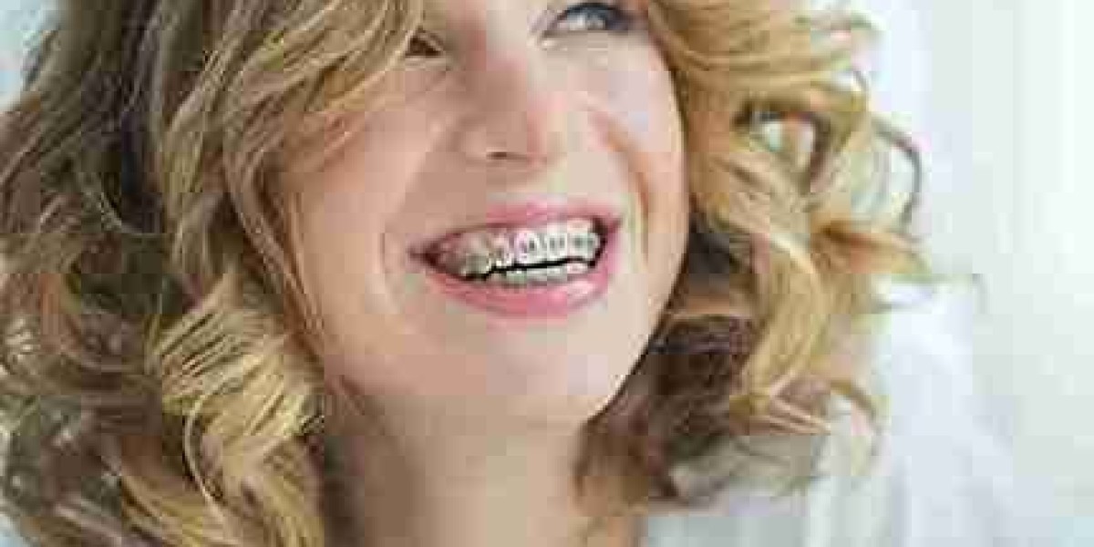 Post-Braces Smiles Benefit from Advanced Whitening Treatments