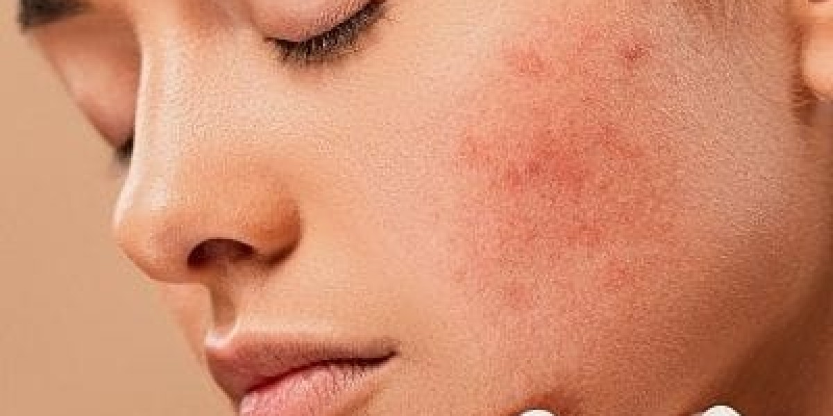 Best Melasma Treatments in Dubai for Summer Skin
