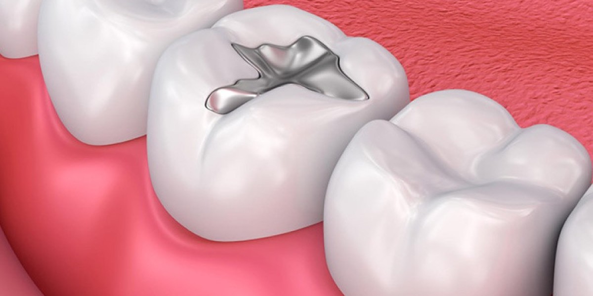Trám răng cửa có bền không? Giải đáp từ chuyên gia phục hình răng