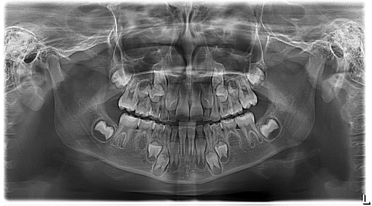 Panoramic Dental X-Ray Cost in Dubai