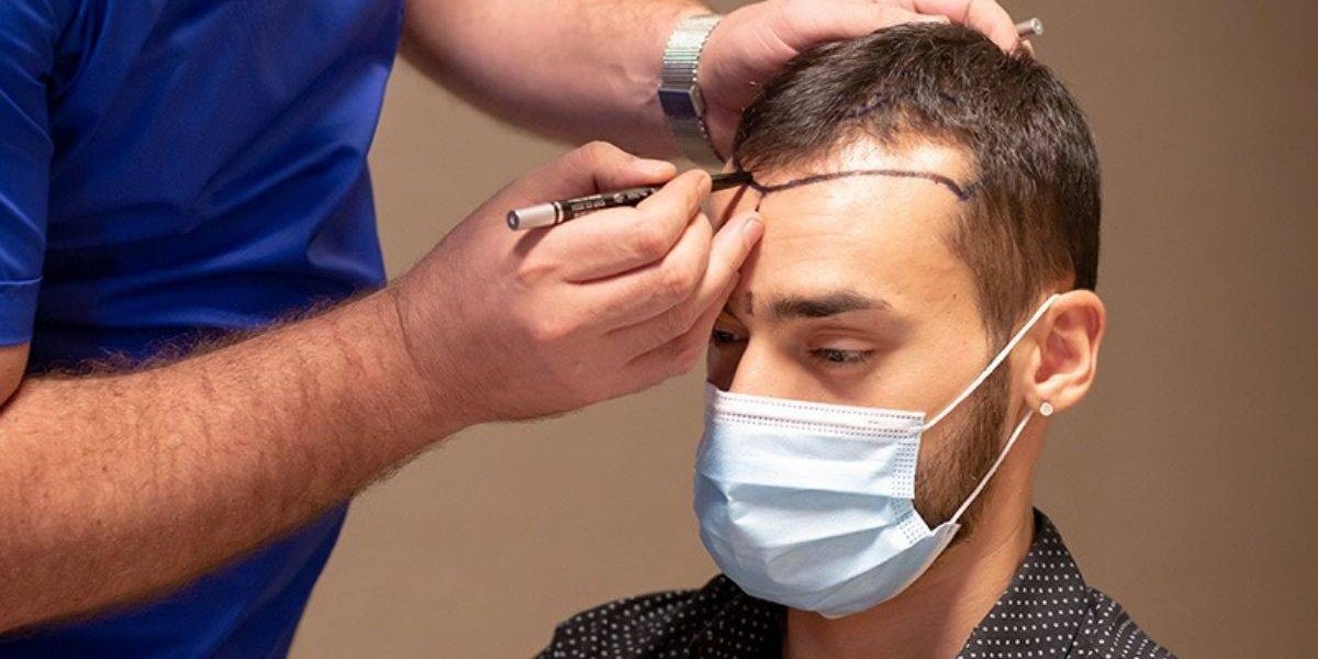 Common Mistakes People Make Before and After Hair Transplant