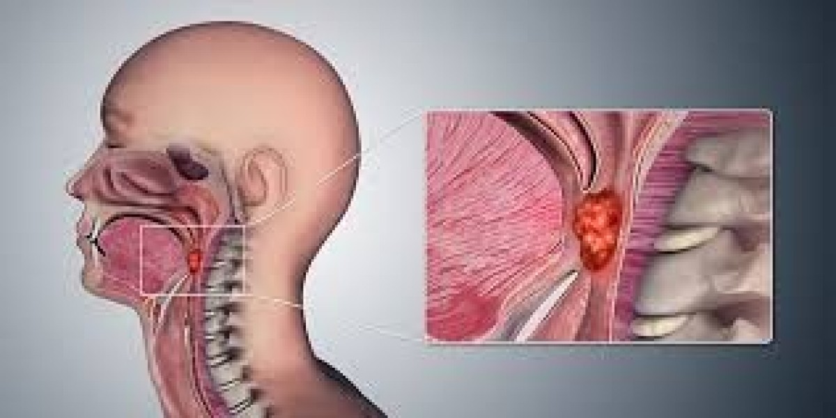 Emerging Trends in Global Nasopharyngeal Carcinoma Market and Forecast Analysis 2030
