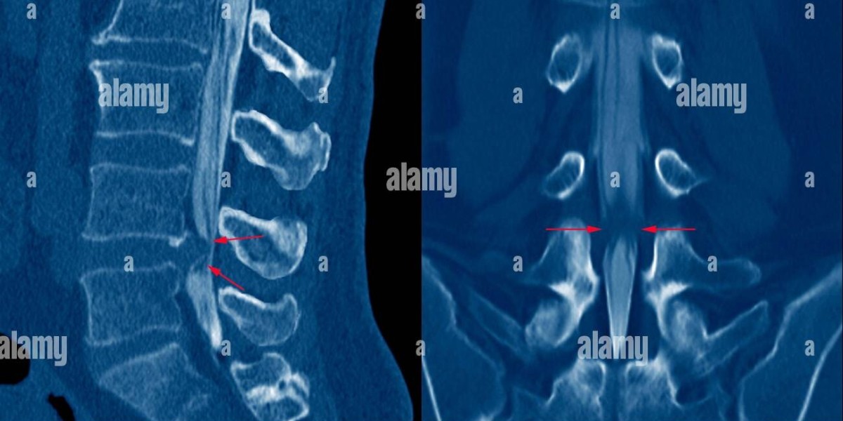 Seeing Clearly: How Spine X-ray and CT Market Growth is Revolutionizing Back Pain Diagnosis