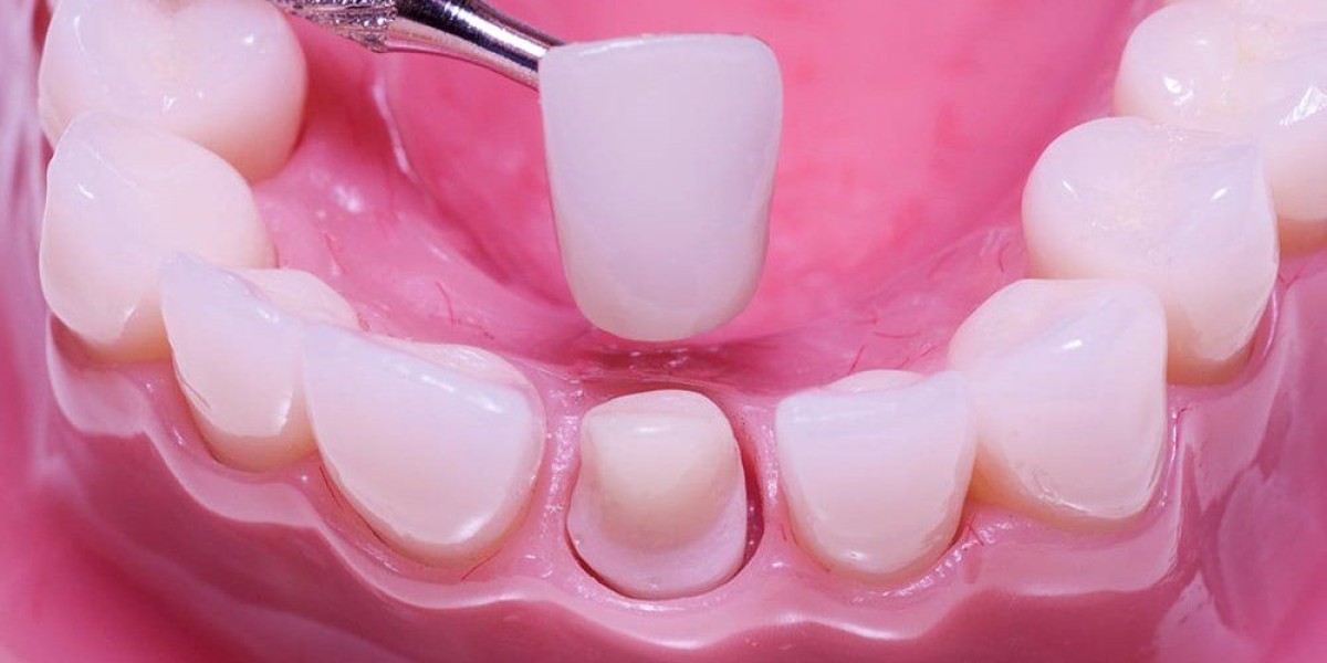 Mài răng bọc sứ có đau không? Giải đáp chi tiết từ chuyên gia phục hình răng 