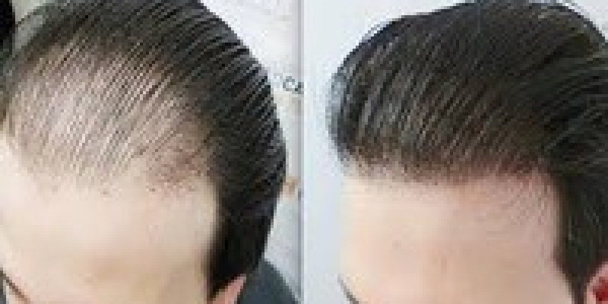 Hair Transplant in Dubai: Separating Myths from Facts