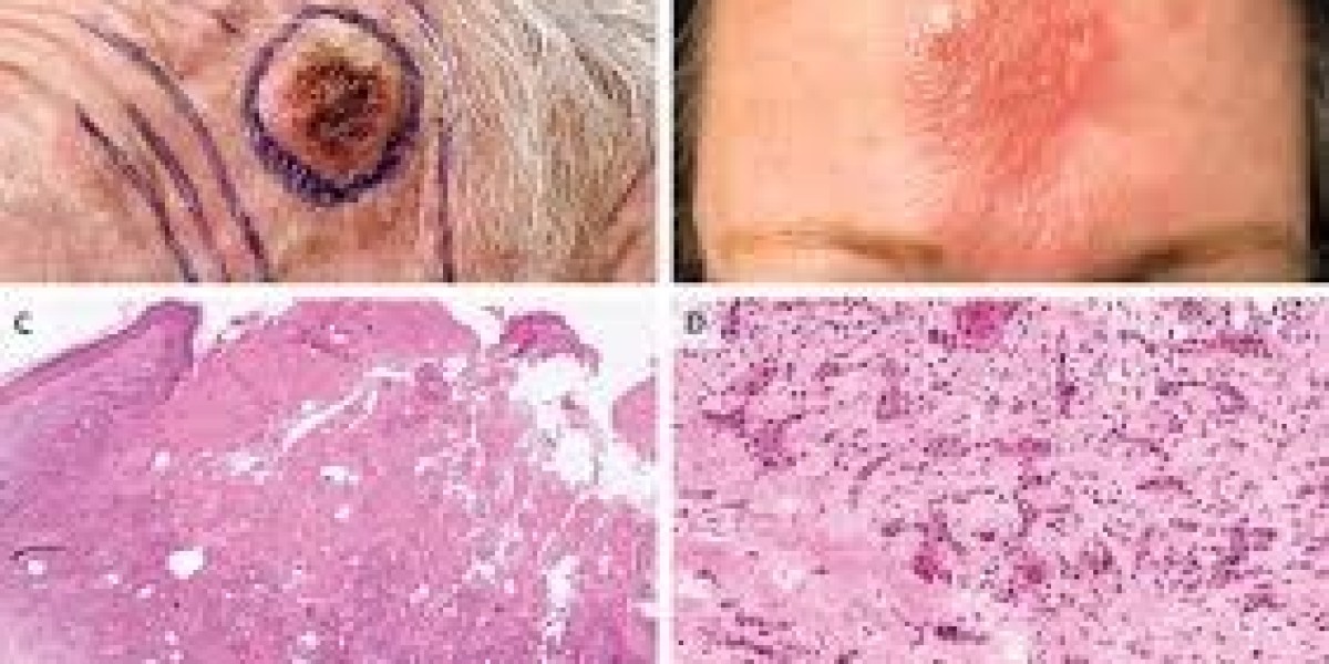 Cutaneous Squamous Cell Carcinoma Market Size, Epidemiology, Trends, and Forecast 2024-2034
