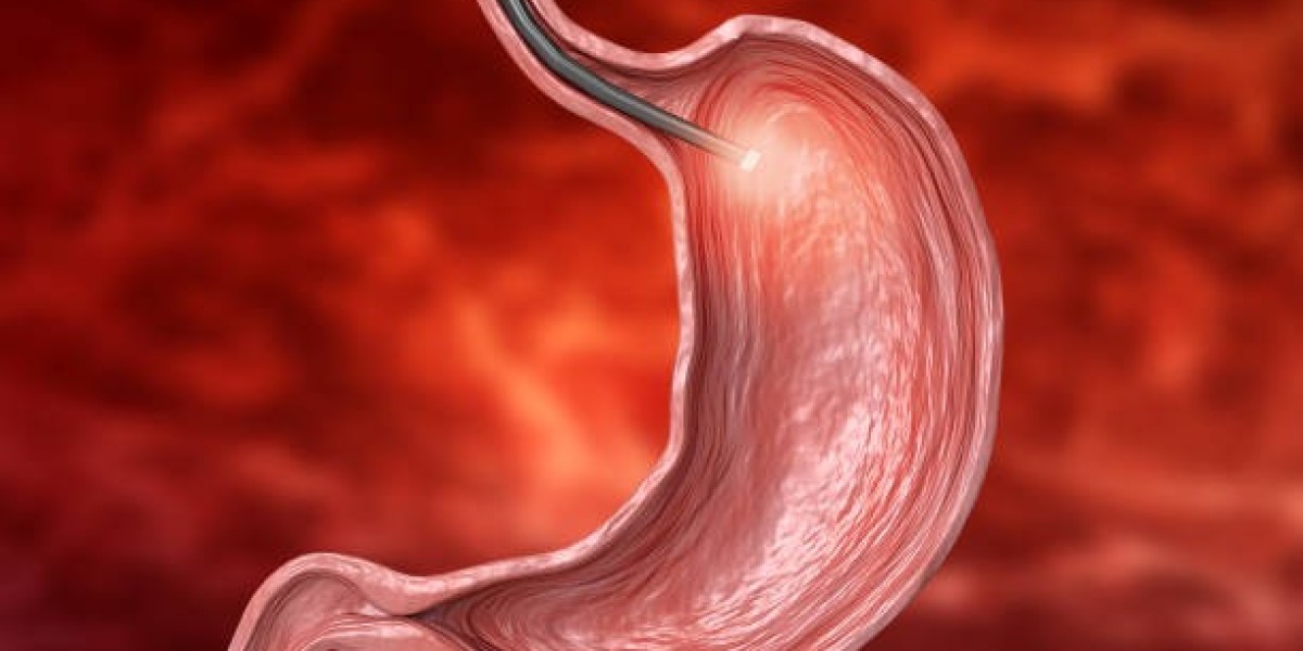 Recovery After Gastric Balloon Riyadh: Your Path to a Healthier You