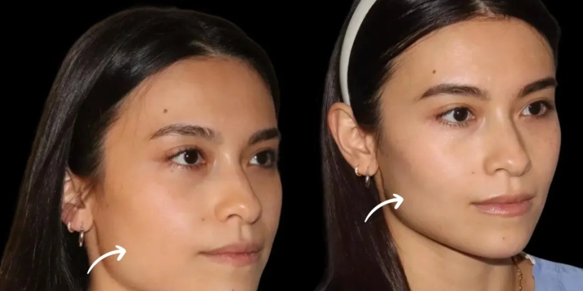How Dubai’s Best Plastic Surgeons Use Sculptra Fillers for Facelifts