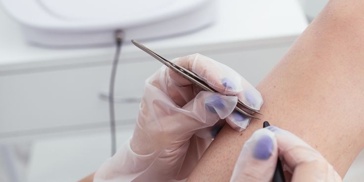 Electrolysis Hair Removal Riyadh: Unveiling Permanent Hair Freedom