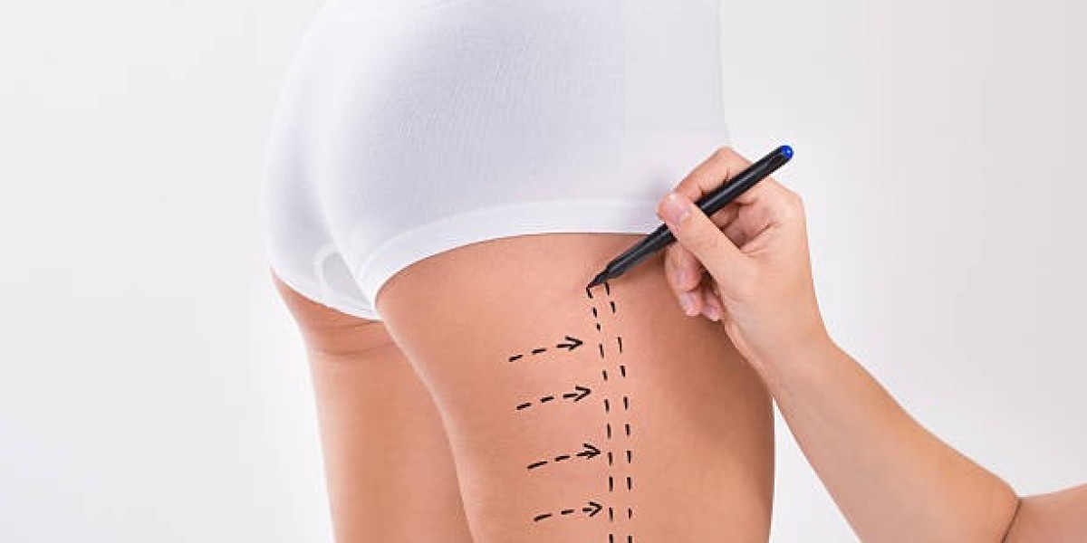 Is Thigh Lift Surgery Right for You?