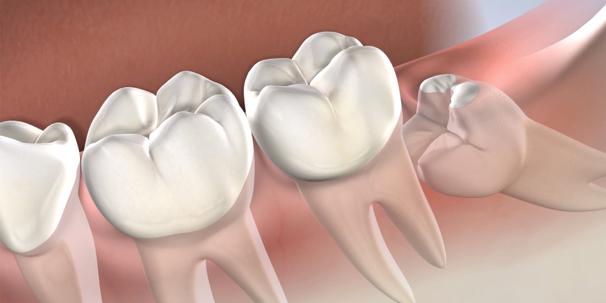 Wisdom Tooth Extraction Procedure and Recovery Timeline