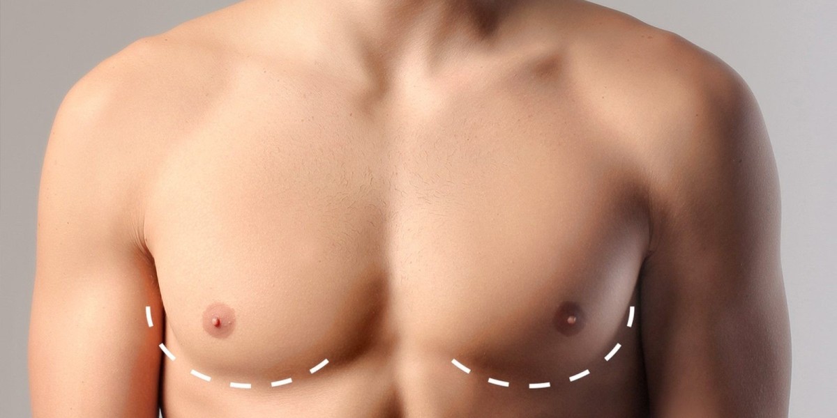 How to Prepare for Gynecomastia Surgery in Riyadh