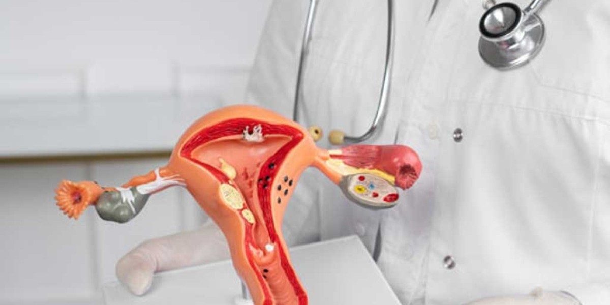 Choosing the Right Medical Oncologist for Uterus Cancer