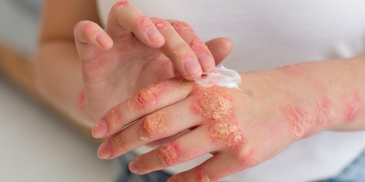 Exploring the Growth of the Atopic Dermatitis Market: Innovations, Challenges, and Future Outlook