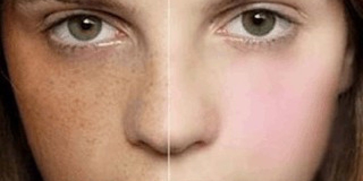 Different Types of Melasma Explained