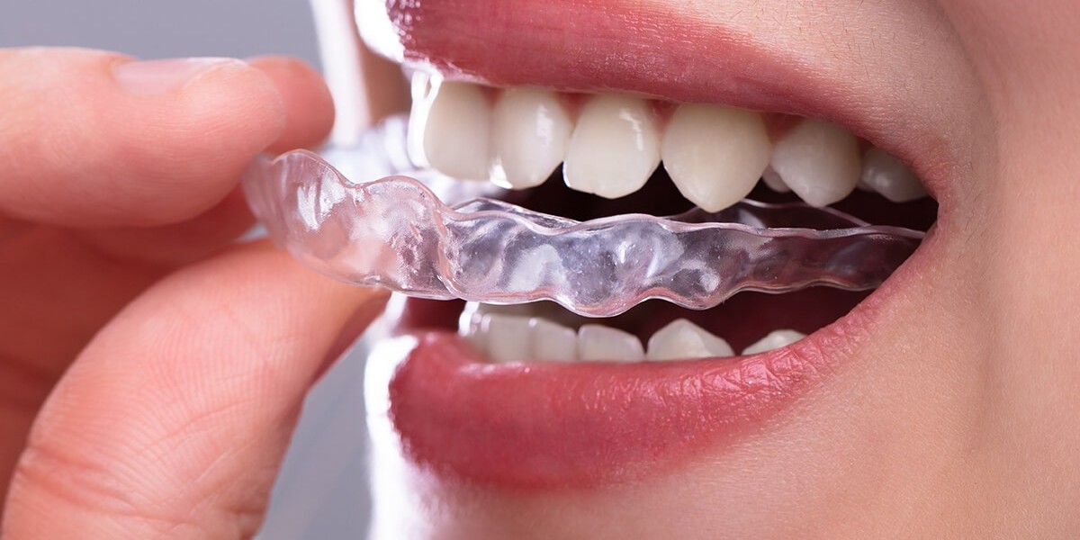 Can Invisalign Braces Treatment Cost Fit Your Wallet?