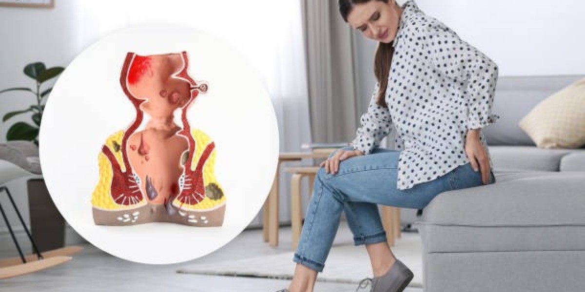 Top Hemorrhoid Treatment in Riyadh for Pain Relief
