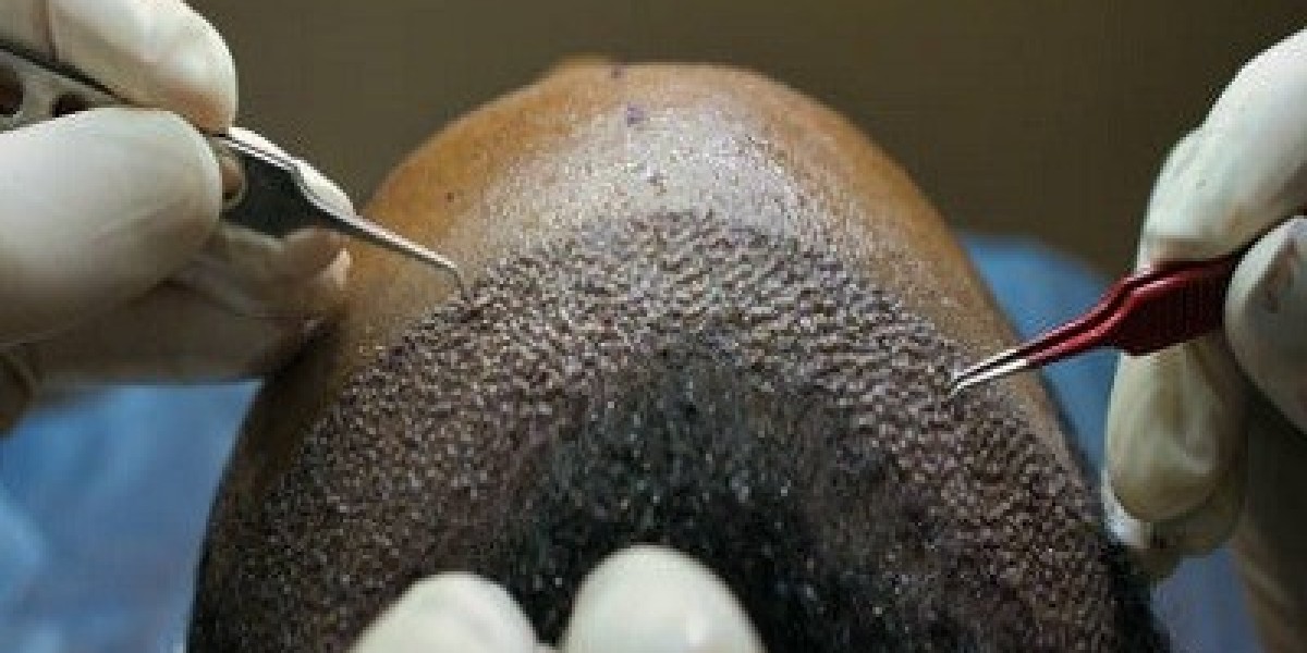 What to Expect During a Hair Transplant Surgery in Islamabad