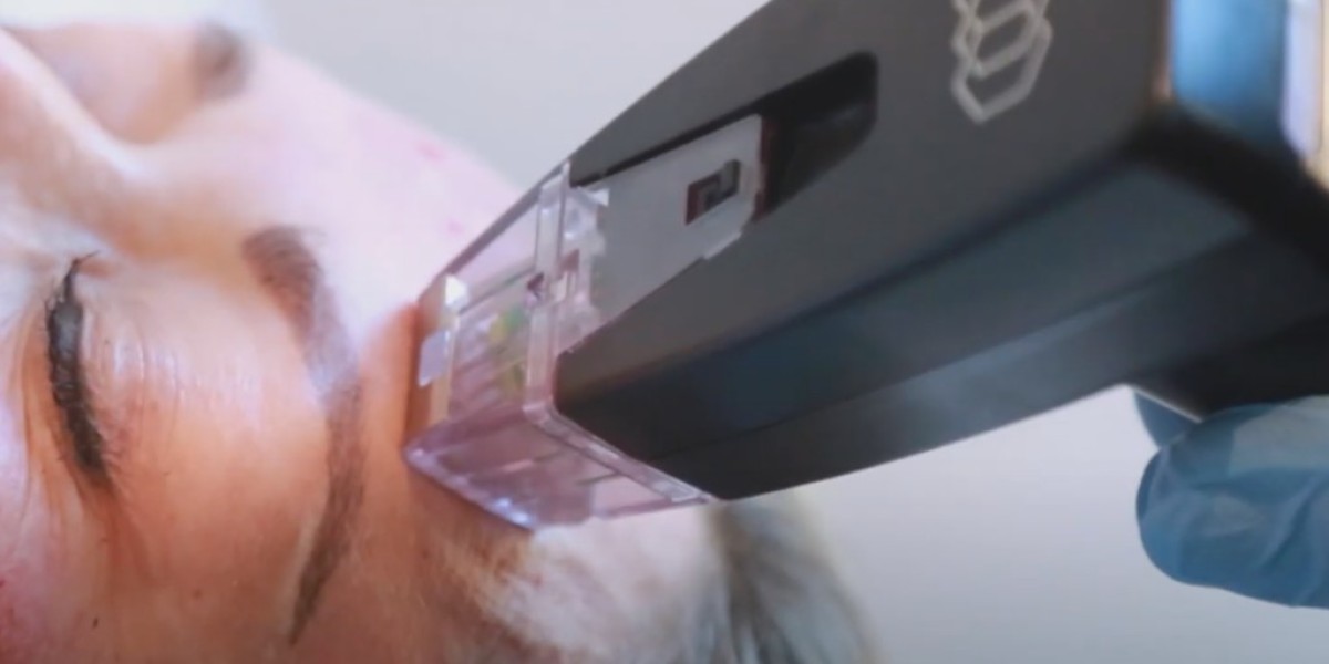 Beauty Elevated Fast with Morpheus8 Treatment in Dubai
