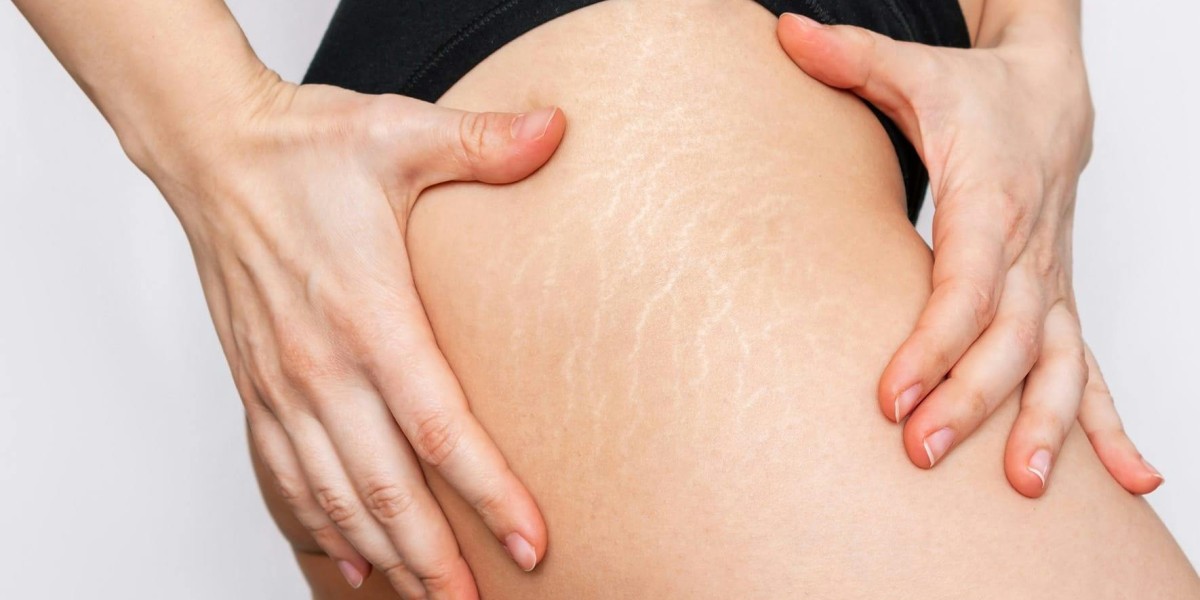 Can Laser Stretch Marks Treatment Smooth Deep Lines?