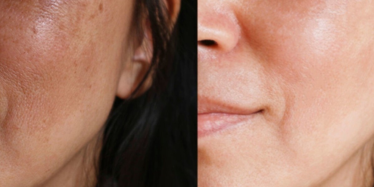 Buying Prescription Skin Creams Without a Doctor – OKDERMO Guide