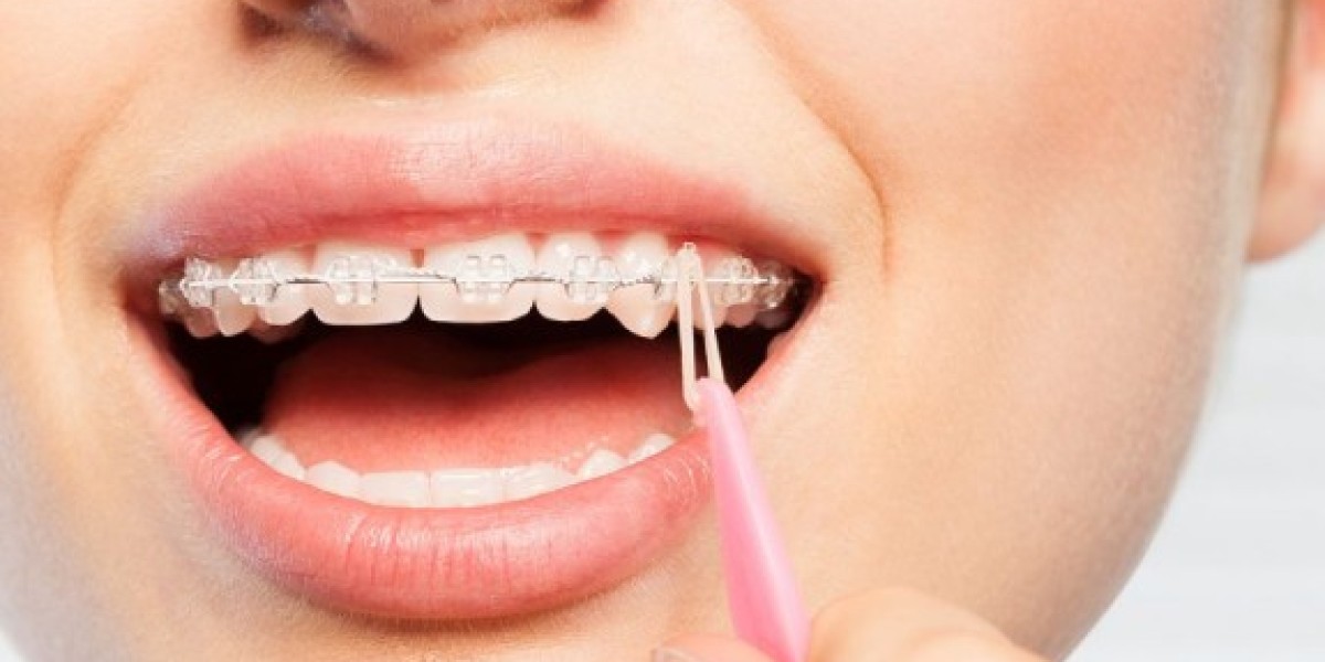 What Are Lingual Dental Braces and Are They Right for You?
