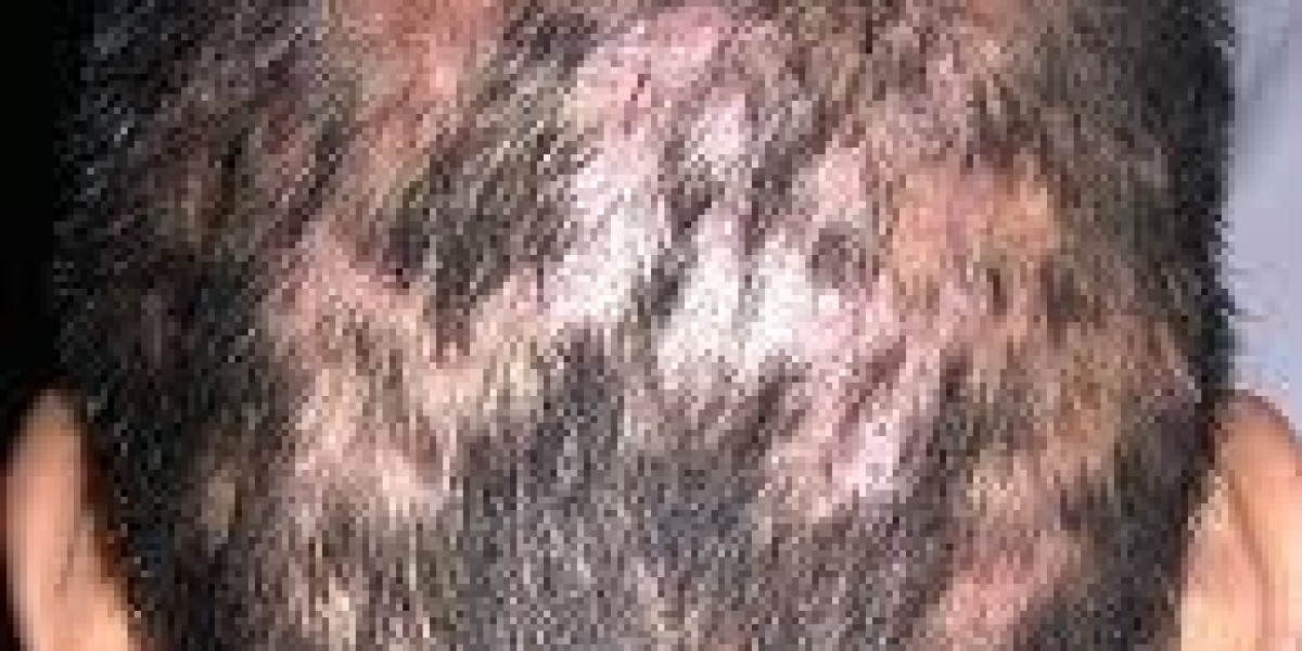 Global Alopecia Market Size, Share, Trends, and Forecast 2021–2030