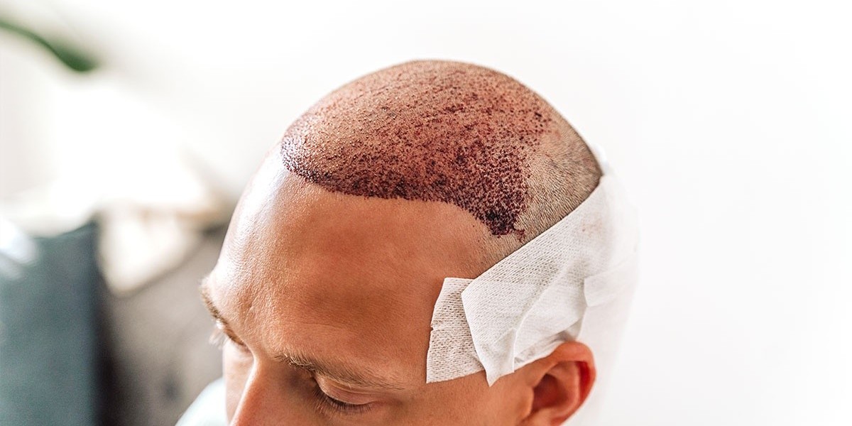 Hair Transplant that Delivers a Youthful and Fresh Look