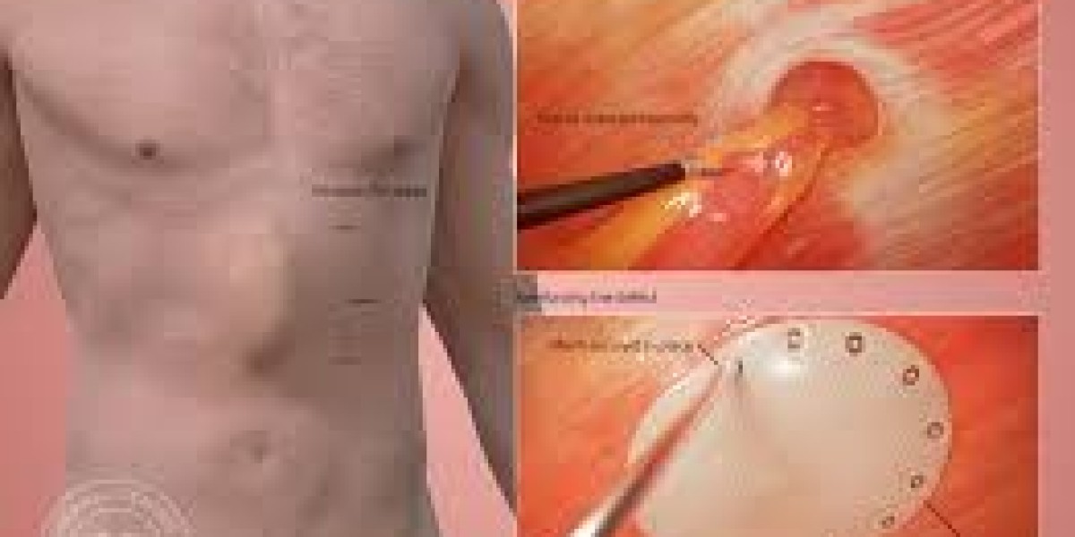 Global Market Forecast: Ventral Hernia Treatment Trends and Opportunities Through 2032