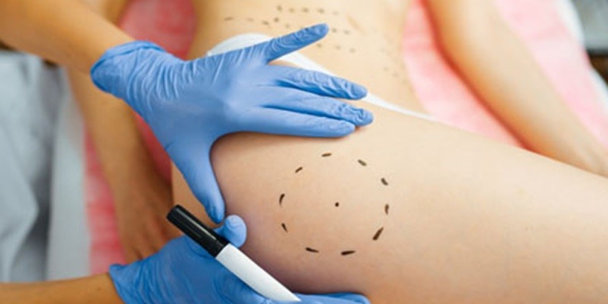 Riyadh Thigh Lift Before & After