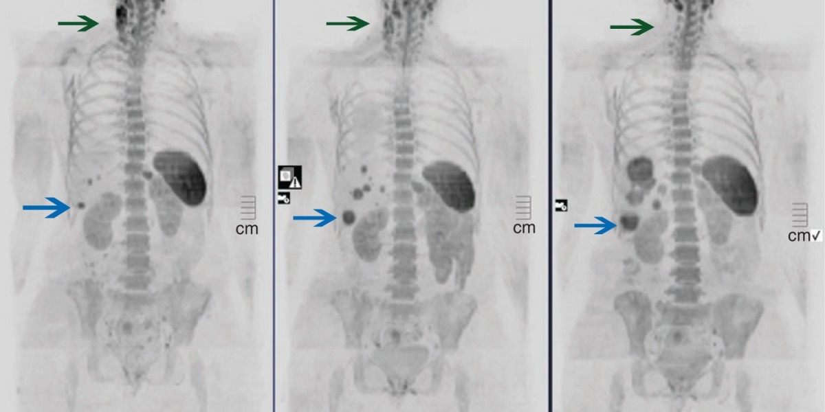 Metastatic Bone Cancer Market Outlook: Key Trends, Innovations, and Forecasts