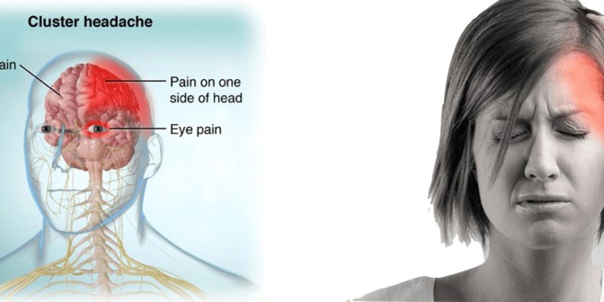 Taming the "Suicide Headache": Urgent Innovation Fuels the Cluster Headache Market