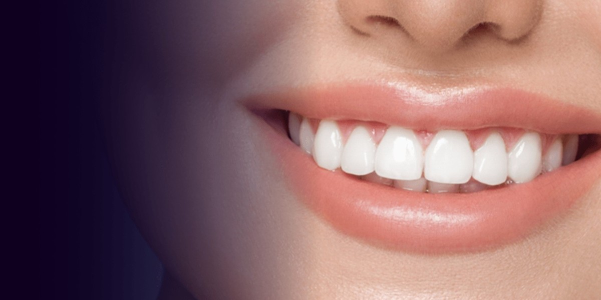 Dubai Cost of Whitening for Smoking-Stained Teeth