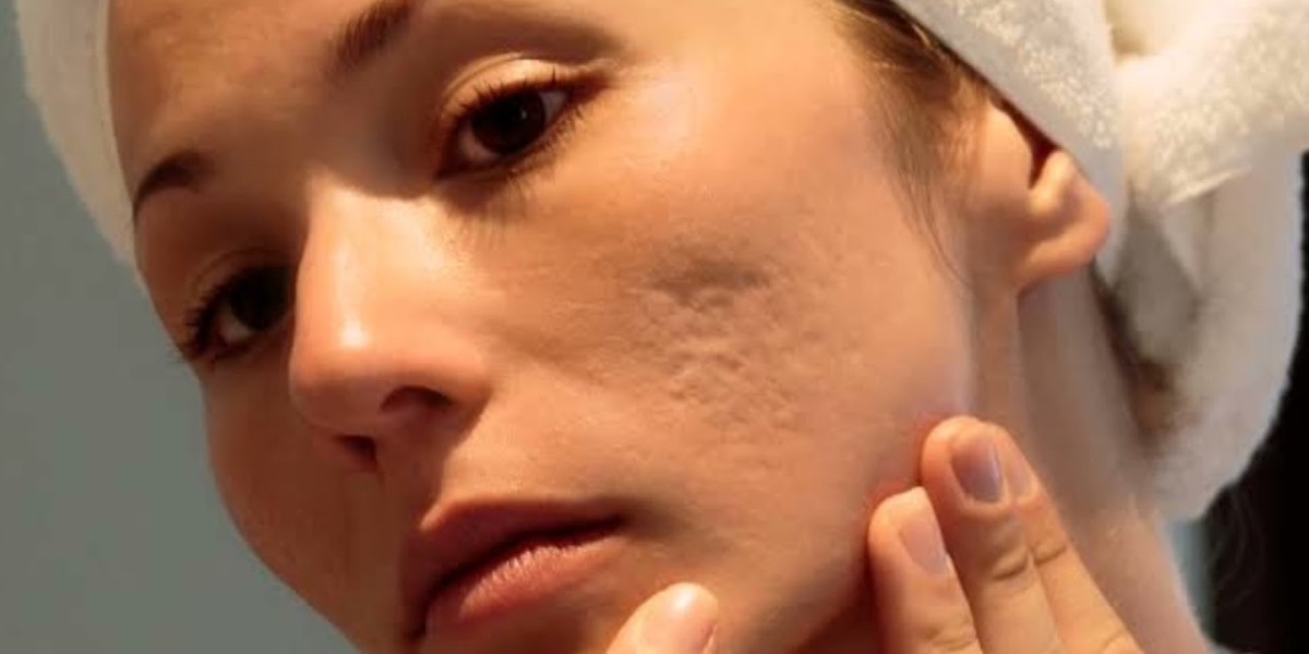 Red vs. Brown Acne Scars: Customized Treatment in Islamabad