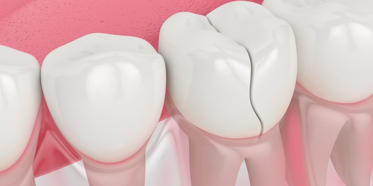 Chipped or Broken Tooth? Here’s How to Handle It Immediately