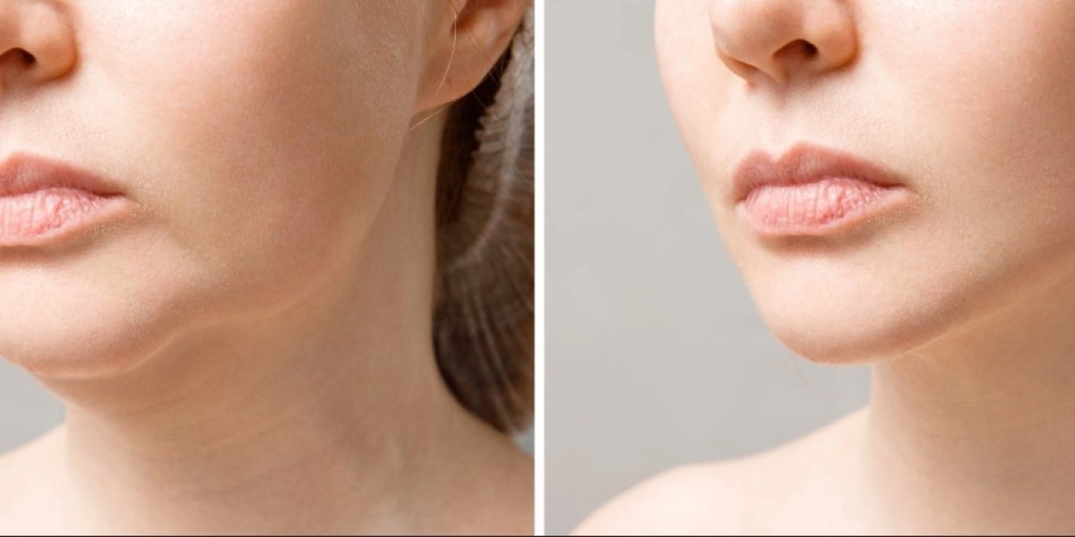 Double Chin Free in Riyadh – Your Treatment Options