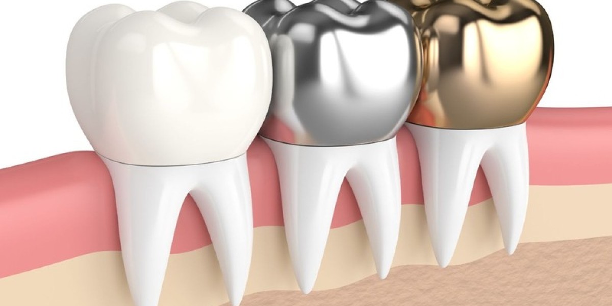 Bọc răng sứ bao nhiêu tiền 1 răng? Những điều cần biết trước khi quyết định 