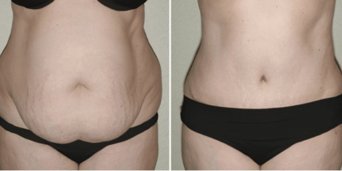 From Loose Skin to Toned Abs with a Tummy Tuck
