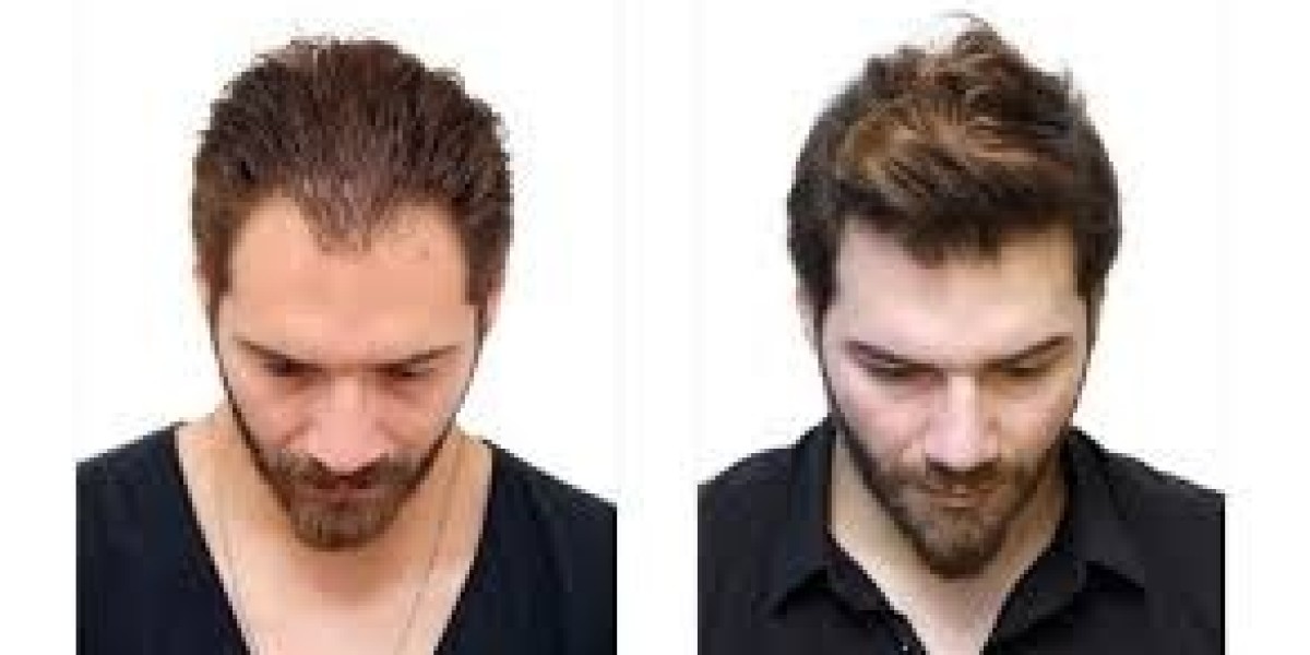 هل زراعة الشعر مؤلمة؟ إليك الحقيقة الكاملة